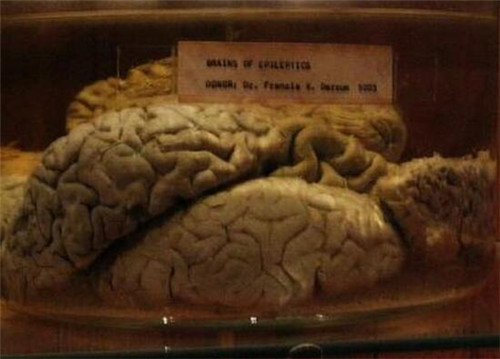 世界上最恐怖的博物馆：双头尸体，爱因斯坦大脑切片都在这