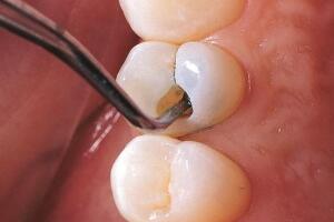 有蛀牙怎么办，怎么治疗蛀牙(需就医/蛀牙洞需及时补/早晚刷牙)