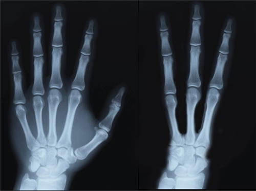 刚出土的千年干尸只有3手指3脚趾，难道真是外星人？